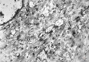 M,29y. | embryonal rhabdomyosyrcoma in testicular teratoma M,29y. | embryonal rhabdomyosyrcoma in testicular teratoma